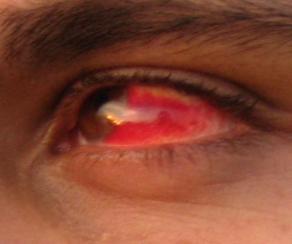 Behold my red eye...